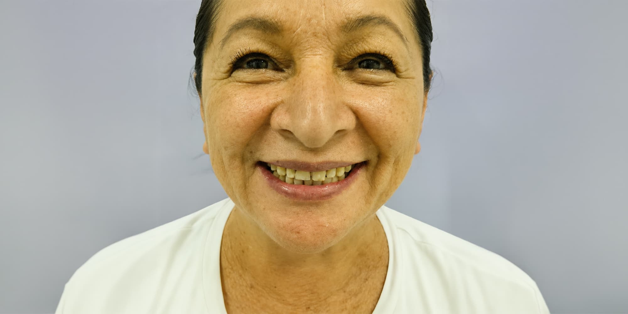 Antes — Diseño de sonrisa con 20 carillas