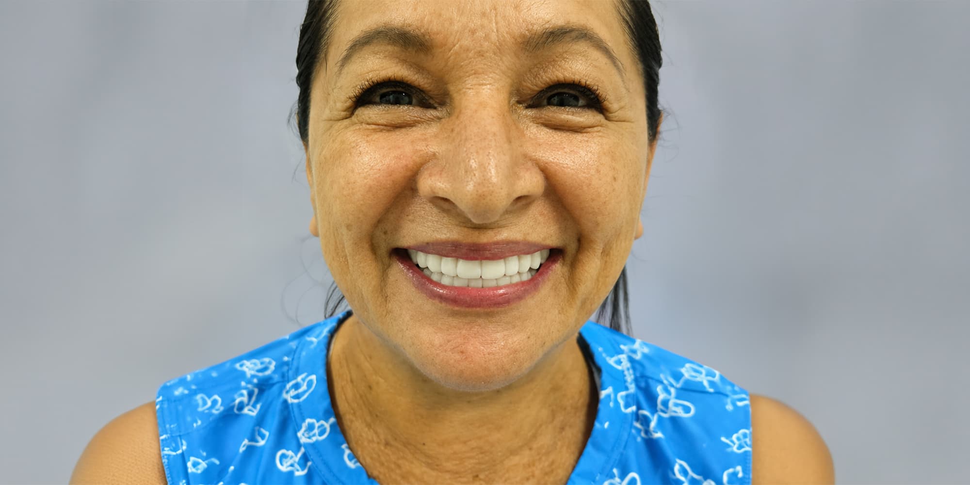 Después — Diseño de sonrisa con 20 carillas